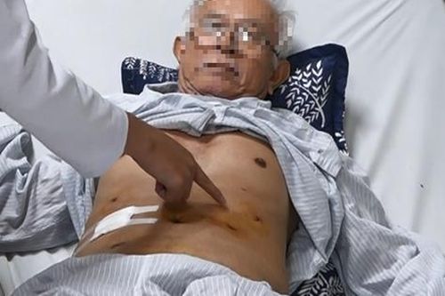 Hội chứng Peutz-Jeghers: Nguyên nhân, triệu chứng, phòng ngừa và điều trị