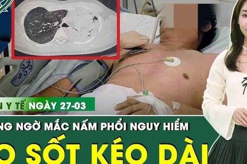 Bản Tin Y Tế 27/3: Ho sốt kéo dài, người đàn ông nguy kịch vì nhiễm nấm phổi