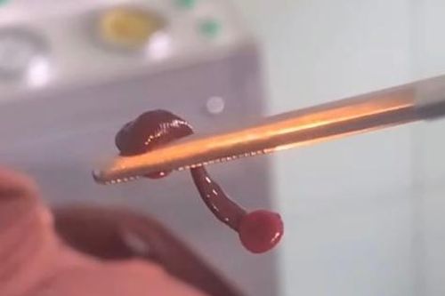 Phát hiện con vắt sống trong mũi người đàn ông suốt nhiều ngày