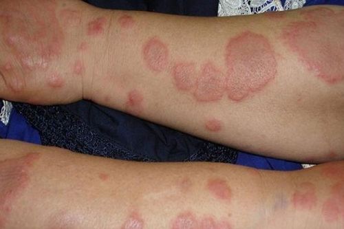 Hồng ban nút: Nguyên nhân, biểu hiện, cách điều trị và phòng bệnh
