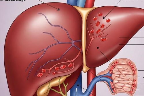 Hội chứng Budd-Chiari: Nguyên nhân, triệu chứng, cách điều trị và dự phòng