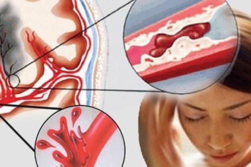 Tại sao đột quỵ ngày càng trẻ hóa?