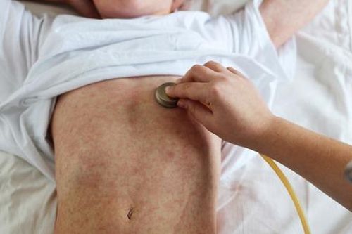 7 yếu tố dẫn tới bệnh sởi diễn tiến nặng, nguy cơ tử vong cao