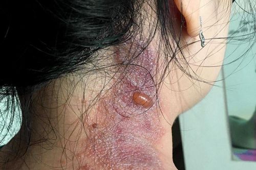 Hàng chục bệnh nhân đến viện do kiến ba khoang đốt dù không phải mùa cao điểm