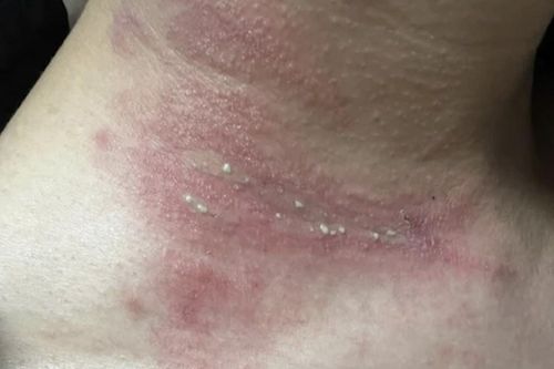 Loài côn trùng bé bằng hạt gạo có độc tính mạnh gấp 12 - 15 lần nọc rắn hổ
