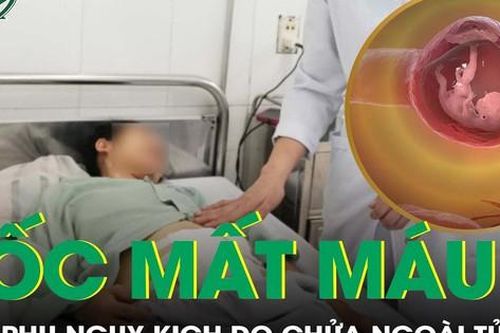 Cứu kịp thời sản phụ sốc mất máu do thai ngoài tử cung vỡ dính chặt đại tràng