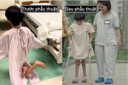 Sau 12 năm di chuyển bằng đầu gối, bé gái lần đầu được đi bằng chính đôi chân mình