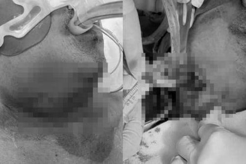 Chủ quan đau răng không ngờ bị sốc nhiễm khuẩn, suy đa tạng nguy kịch