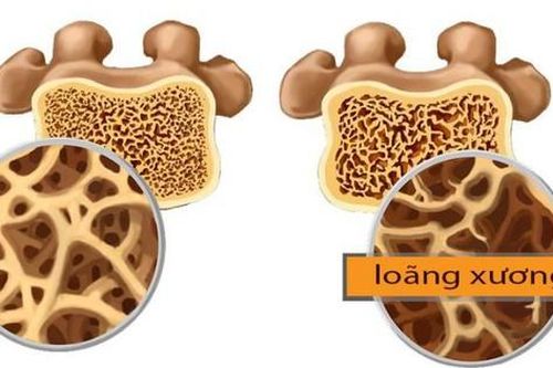Những điều nên và không nên làm khi bị loãng xương
