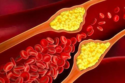 Hẹp động mạch cảnh: Nguyên nhân, biểu hiện, cách điều trị và phòng bệnh