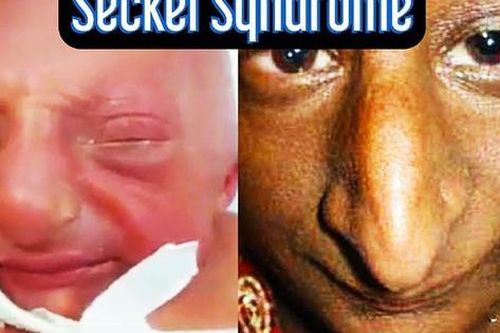 Hội chứng seckel: Nguyên nhân, biểu hiện, cách điều trị và phòng bệnh