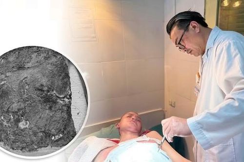 Trẻ 14 tuổi bị nhiễm trùng nặng do điều trị bỏng bằng thuốc nam