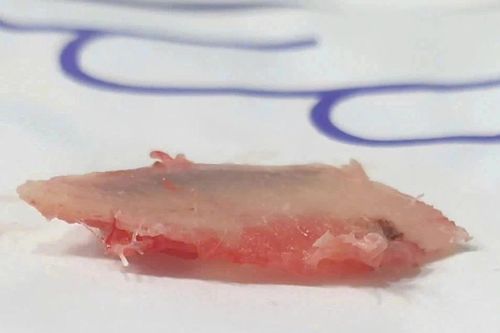 Thủng phổi do mảnh gãy của xương sườn