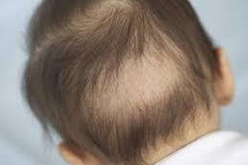 Bé 5 tuổi bị rụng tóc nhiều là thiếu chất gì?