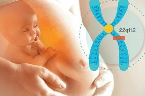 Hội chứng DiGeorge: Nguyên nhân, biểu hiện, cách điều trị và phòng bệnh
