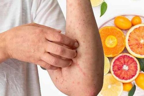 10 lưu ý về chế độ dinh dưỡng cho bệnh sởi