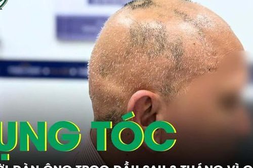 Dùng thuốc chống rụng tóc không rõ nguồn gốc, người đàn ông trọc đầu sau 3 tháng