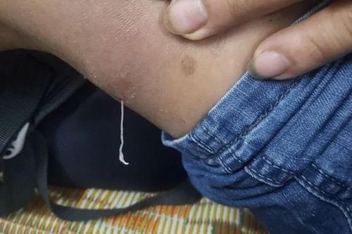 Bệnh giun rồng là gì?