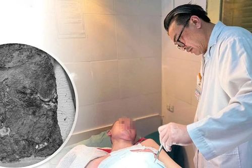 Tự điều trị bỏng, trẻ nhiễm trùng nặng