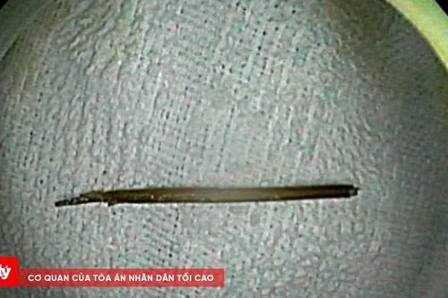 Bị thủng đại tràng vì ngậm tăm khi ngủ