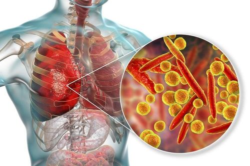Người bị sốt, ho không rõ nguyên nhân tại Nga liên quan đến nhiễm vi khuẩn Mycoplasma
