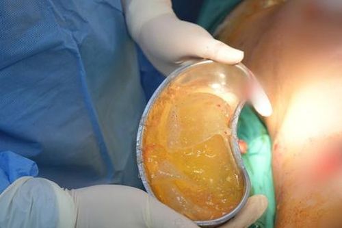 Hy hữu: Người phụ nữ bị vỡ túi nâng ngực khi đang mang thai