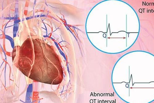 Hội chứng QT kéo dài: Nguyên nhân, biểu hiện, cách điều trị và phòng bệnh