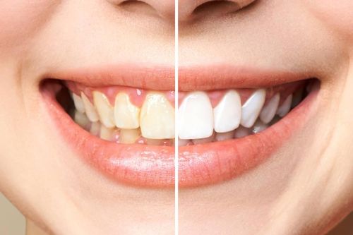 Răng ố vàng làm sao cho trắng?
