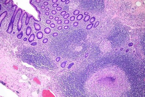 Bị viêm ruột thừa do… vi khuẩn lao