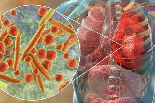 Bộ Y tế thông tin về 'bệnh lạ' ở Nga, Việt Nam chưa phát hiện ca mắc