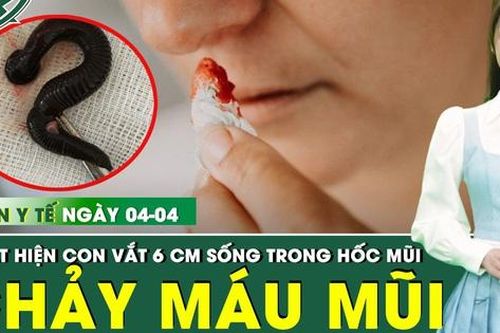 Bản tin Y tế 4/4: Con vắt dài hơn 6 cm sống cả tuần trong mũi bệnh nhân