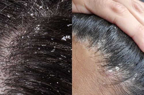 Da đầu bị gàu nhiều và tái phát liên tục - Làm sao để nhanh khỏi?