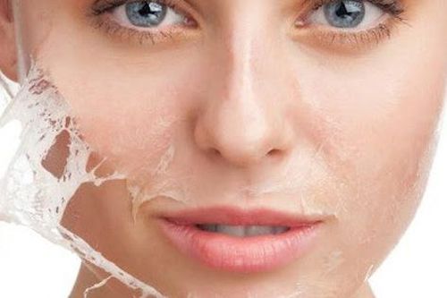 Ưu điểm và rủi ro khi peel da