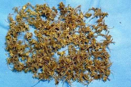 Người đàn ông bị tắc ruột do nuốt hàng ngàn mảnh xương rắn