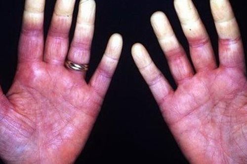 Hội chứng Raynaud: Nguyên nhân, biểu hiện, cách điều trị và phòng bệnh