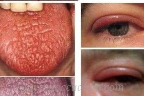 Hội chứng Sjogren: Nguyên nhân, biểu hiện, cách điều trị và phòng bệnh