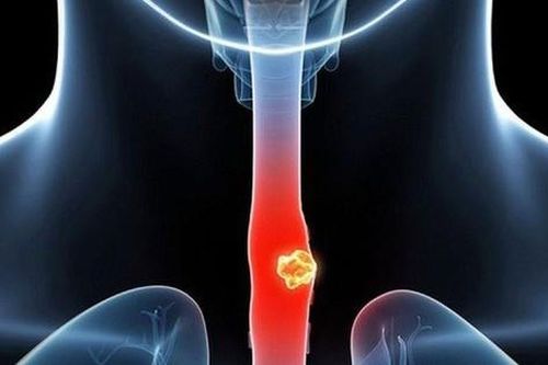 Loét thực quản: Nguyên nhân, biểu hiện, cách điều trị và phòng bệnh