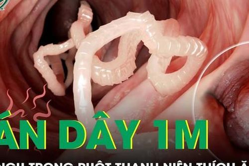 Phẫu thuật gắp sán dây dài gần 1m từ ruột nam thanh niên nghiện ăn đồ sống