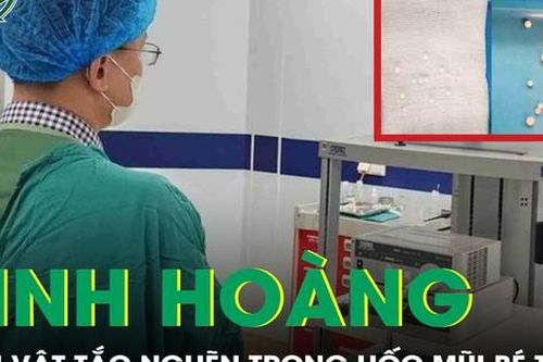Gắp 12 dị vật mắc trong hốc mũi bé trai 3 tuổi