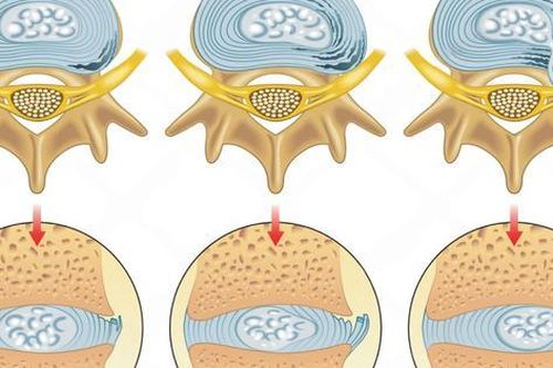 Rách bao xơ đĩa đệm: Phát hiện sớm, tránh biến chứng nặng nề