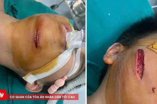 Bé trai bị chó nhà cắn rách mặt