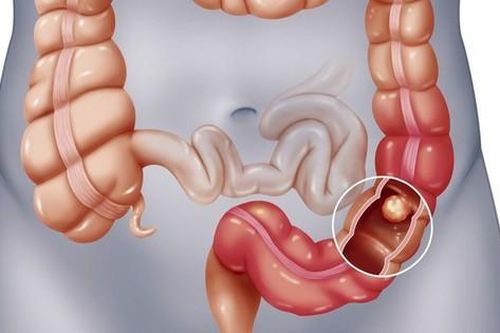 Liệt ruột: Nguyên nhân, biểu hiện, cách điều trị và phòng bệnh
