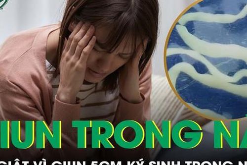 Cô gái 25 tuổi co giật suốt 2 năm vì giun sống dài 5cm nằm trong não