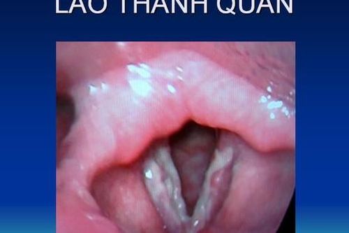 Lao thanh quản: Nguyên nhân, biểu hiện, cách điều trị và phòng bệnh