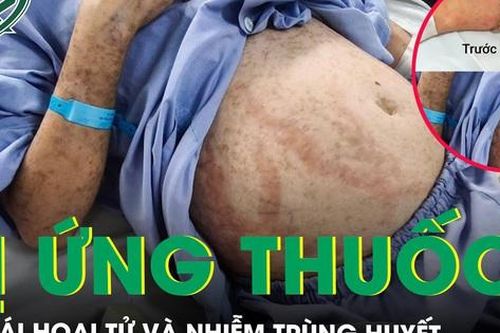 Tự ý uống thuốc, cô gái suýt mất mạng do hoại tử và nhiễm trùng huyết