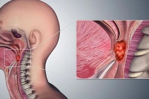 Bác sĩ Bệnh viện K chỉ ra dấu hiệu nhận biết ung thư vòm hầu