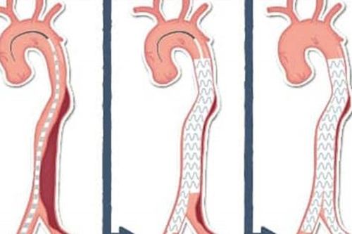 Lóc tách động mạch chủ: Nguyên nhân, biểu hiện, cách điều trị và phòng bệnh