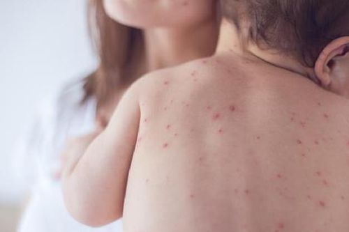 Bộ Y tế khuyến cáo sau ca bệnh người lớn đầu tiên tử vong vì bệnh sởi