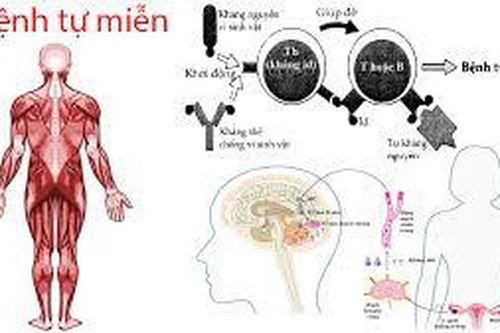 Bệnh viêm gan tự miễn có di truyền không?