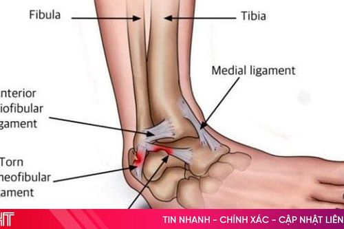 Nhận biết và xử trí khi bị đứt, chấn thương dây chằng cổ chân lúc chơi thể thao